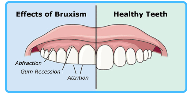 How to Stop Grinding Teeth While Sleeping – Dealing With Bruxism